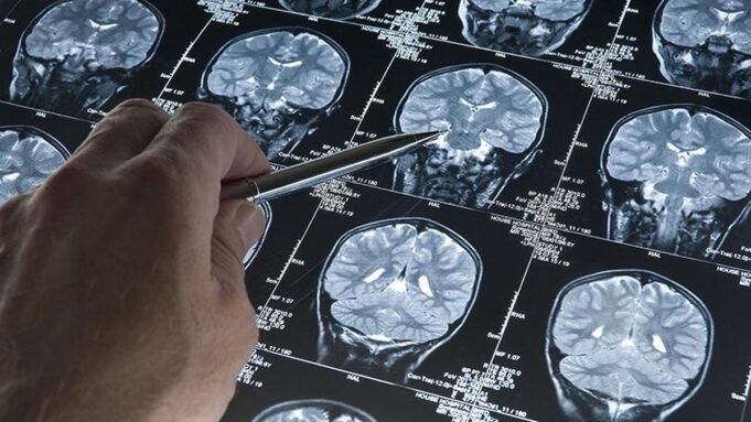 স্ট্রোক পুনর্বাসন একটি মূলধারার অনুশীলন করা জরুরী প্রয়োজন | BanglaKagaj.in Google Preferred Source